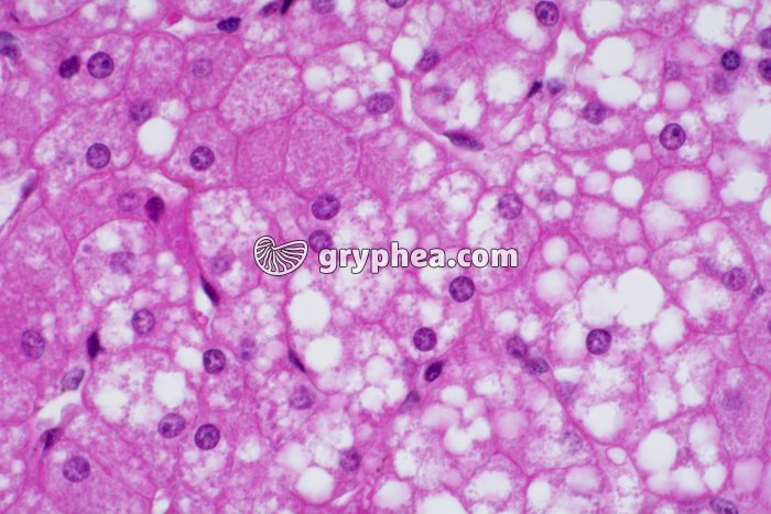 Foie pathologique hépatocytes x200 - gryphea.org